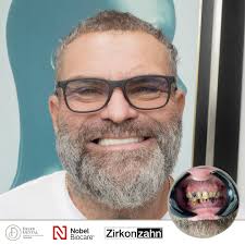 Esta es la nueva sonrisa de don William. ¿Cómo lo logramos? Colocamos 12  implantes dentales (6 en cada arco) que sostienen una prótesis fija  atornillada, fabricada con dientes de circonio. Este tratamiento,