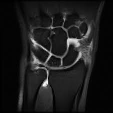 Patients with tfcc injury will present with. Tfcc Tear Palmer Ia Radiology Case Radiopaedia Org