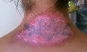 However, blistering may occur in some places due to pigment density or color. Lighten Up Laser Risks On Non Laser Tattoo Removal Methods Pictures May Be Graphic To Some