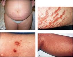 Image result for pruritic urticarial papules and plaques of pregnancy