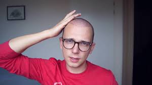De specialisten van nationaal huidcentrum voeren alle haartransplantaties volgens de nieuwste technieken uit. Haartransplantatie In Turkije Vlog5 11 Dagen Na De Behandeling Youtube