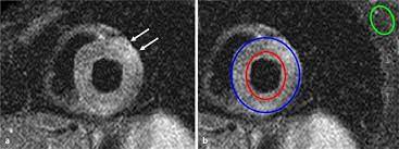 Acute coronary syndrome (acs) is frequent and prognostically relevant. Mrt Bei Myokarditis Springerlink