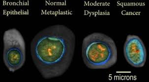 Screening is meant to find cancer in people who do not have symptoms of the disease. Data Shows Visiongate S 3d Imaging Platform A Eurekalert