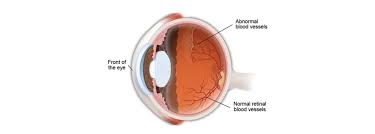Image result for Decreased Visual Acuity