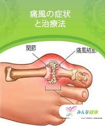 痛風の症状と治療法 みんな健康 痛風 治療 健康
