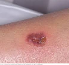 Image result for Impetigo