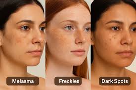 Image result for Melasma