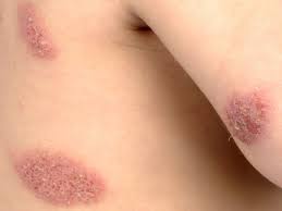 Image result for Eczema nummulare
