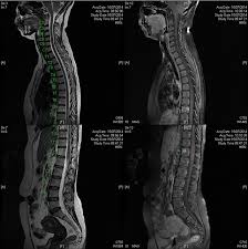 There are currently no formal recommendations to guide the differential diagnosis workup between the evolution of lymphoma or a solid cancer and a granulomatous reaction associated with neoplasia. Multisystemic Sarcoidosis Important Lessons Learnt From One Of The Great Imitators Bmj Case Reports