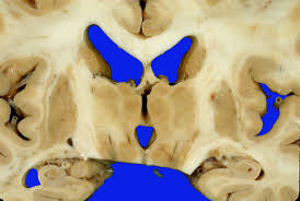 Image result for Pallidotomy