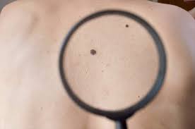 If you aren't sure which type of skin cancer. Common Types Of Benign Non Cancerous Skin Growths