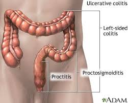 Ulcerative Colitis A Few Facts Ulcerative Colitis Colitis Natural Cures