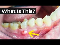 Image result for Periodontal Abscess