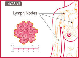 In stage 0 breast cancer, cells are only in the milk ducts. Breast Cancer Stage 3 Treatment Options Modern Cancer Hospital Guangzhou China
