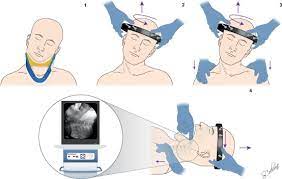 Closed Reduction Of Traumatic Atlantoaxial Rotatory Subluxation With Type Ii Odontoid Fracture Sciencedirect