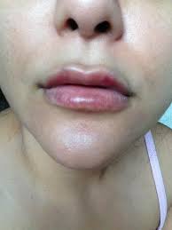 We did not find results for: Can Swelling Be Worse On The 2nd Day After Juvederm Lip Injections Photo
