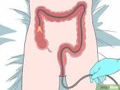 Resultado de imagen para "sangrado rectal" sangre color rosa