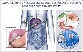 During a gallbladder attack, abdominal pain usually lasts about six to 12 hours but might persist longer. Gallbladder Post Surgery Effects And Recovery Southlake General Surgery