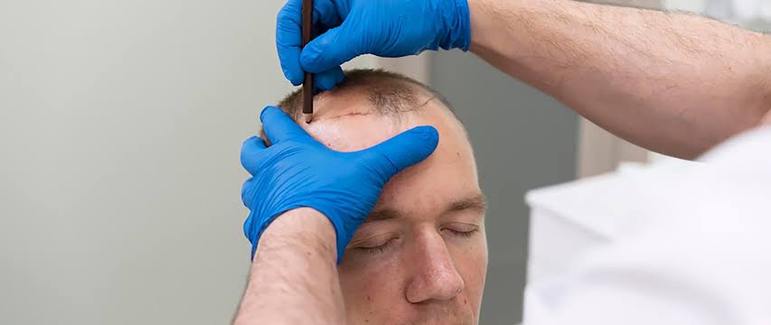 Why Does A Hair Transplant Appear Natural Years After The Procedure?