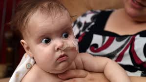 Baby with rare condition comes home for first time