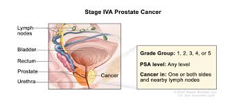 T1 means the cancer is too small to be seen on a scan, or felt during examination of the prostate. Definition Of Stage Iv Prostate Cancer Nci Dictionary Of Cancer Terms National Cancer Institute