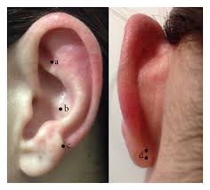 Location Of Ear Acupoints A Shenmen B Muscle