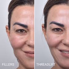 The eyebrows can achieve very minimal lift with threads and he no longer recommends this as a brow lifting option. Thread Lift Sydney 1 Cosmetic Doctors Face Neck Cheek Lift Specialist Clinic