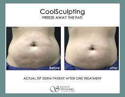 Raving reviews can tell you how well coolsculpting works, but the before and after images found at the bottom of this page will actually show you. Does Coolsculpting Really Work Siperstein Dermatology Group