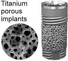 Titanium is widely distributed and constitutes 0.44 percent of earth's crust. Porous Titanium Implants A Review Palka 2018 Advanced Engineering Materials Wiley Online Library