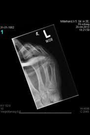 Knochenbruche An Hand Und Fingern Obere Extremitat Hand Und Mikrochirurgie Immanuel Krankenhaus Berlin