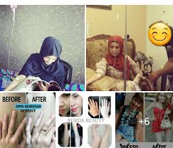 Suntikan intravenous injection melalui iv drip boleh mencerahkan dan menggebukan kulit sekaligus memutihkan kulit dari akar umbi.ianya dilakukan setiap seminggu sekali untuk hasil yang lebih berkesan dan perubahan kulit. Kulit Putih Risiko Suntikan Vitamin C Untuk Memutihkan Kulit