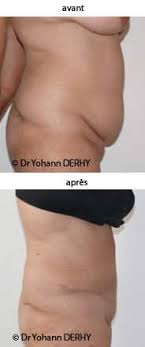 Mais n'oubliez pas que le poids de la grossesse a été. Photos Abdominoplastie Photos Plastie Abdominale Mini Abdominoplastie
