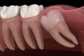 Wisdom Teeth Extraction In Harrisonburg Va Dr Saunders