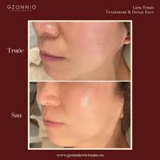 LIỆU TRÌNH TREATMENT & DETOX FACE GZONNIO