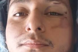 Fundraiser by Ana Jimenez : Let's help to operate Samuel's leg