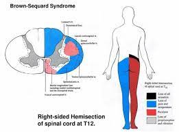 Brown Sequard Syndrome Causes Symptoms Diagnosis Treatment Prognosis