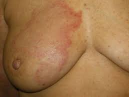 The skin of the breast may also appear pink, reddish purple, or. Carcinoma Erysipeloides Dermnet Nz