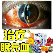 眼睛充血原來是糖尿病 敏性眼睛癢而揉眼睛 咳嗽及用力解便 引起靜脈壓升高 都可能造成結膜下出血 經醫師檢查發現以上病患多数有高血壓 高血脂 高血糖或心血管疾病 因為慢性病患血管彈性變差 構造較脆弱 容 cotton candy machine candy machine kitchen