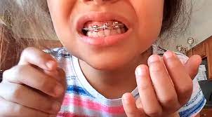 Dental braces are appliances used by orthodontics for aligning and straightening the teeth and helping to position the teeth concerning a patient's bite while aiming to improve their dental health. Texas Orthodontists Warn Against Diy Braces Houston Press