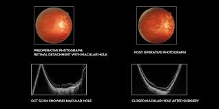 The absence of a retinal tear , corrugations and demarcation lines differentiate it from rhegmatogenous retinal detachment. Retinal Detachment Symptoms Causes And Treatment