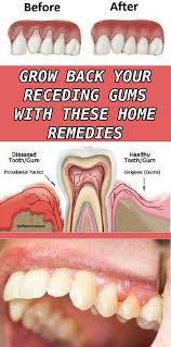 8 Easy Ways To Heal Receding Gums Naturally With Images Gum Disease Treatment Gum Disease Remedies Healthy Teeth