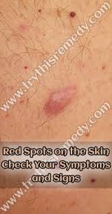 I woke up to red dots on my face and right away it frightened me, it doesn't itch and it doesn't burn but the next time i'll be able to see my doctor is next week and i want to make sure everything is okay until then. Red Spots On The Skin Red Spots On Face Skin Spots Spots On Face
