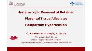 Image result for Retained Placenta