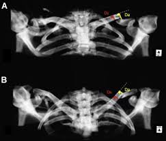 Please remove all obscuring objects and, as always, practice proper radiation protection. Measurement Of Midshaft Clavicle Vertical Displacement Is Not Influenced By Radiographic Projection Sciencedirect