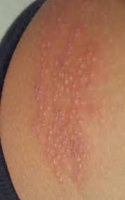 Sie breitet sich gürtelförmig im versorgungsgebiet eines oder mehrerer nerven meist am rumpf aus und beschränkt sich in aller regel auf eine körperhälfte. Ist Das Gurtelrose Gesundheit Haut