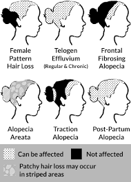 It information and portraits haircut for thinning hair in front female posted by junita at february, 15 2010. Is My Temporal And Frontal Hair Loss Frontal Fibrosing Alopecia