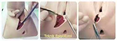 So untuk bakal mommy yang berpantang, saya rekomen kamu ready2 suplimen vit c, zink dan pil kalsium. Luka Episotomi Lovesihatblog