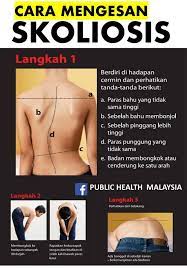 Examples of translating «bengkok» in context Remaja Cara Mengesan Tulang Bengkok A K A Skoliosis Facebook