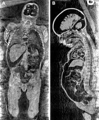 E' mia zia,la sorellina di mia madre che si chiama come lei.a nostra insaputa e senza alcuna autorizzazione l'hanno rovinata. Multidetector Ct Investigation Of The Mummy Of Rosalia Lombardo 1918 1920 Sciencedirect