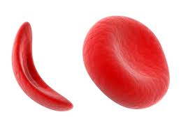 It is a blood disorder that is characterized by fewer amounts of healthy red blood cells, this makes it difficult for adequate oxygen. Sickle Cell Anaemia And Stem Cells Cells4life